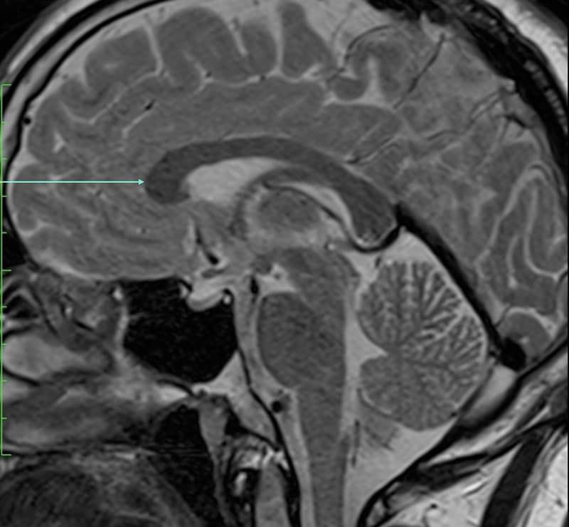 Midline sagittal T1 brain MRI with an arrow marking the genu of the corpus callosum